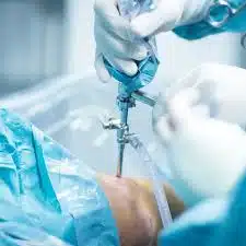 العلاج الجراحي ضروريًا لتآكل غضروف الركبة