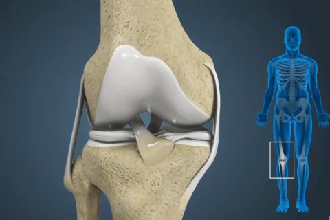 الفرق بين تآكل الغضروف وتمزق الغضروف الهلالي