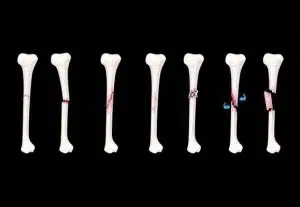 عمليات كسور العظام وعلاجها