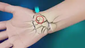 ما هي تكلفة عملية العظمة الزورقية في اليد؟