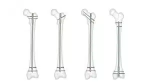 كل ما تحتاج معرفته عن عملية المسمار النخاعي