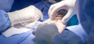 الدليل الشامل لعملية تثبيت مفصل اليد في مصر