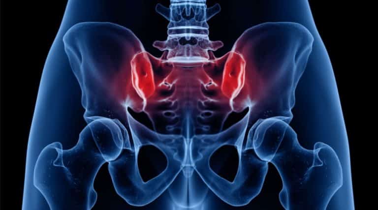 التهاب مفصل الحوض