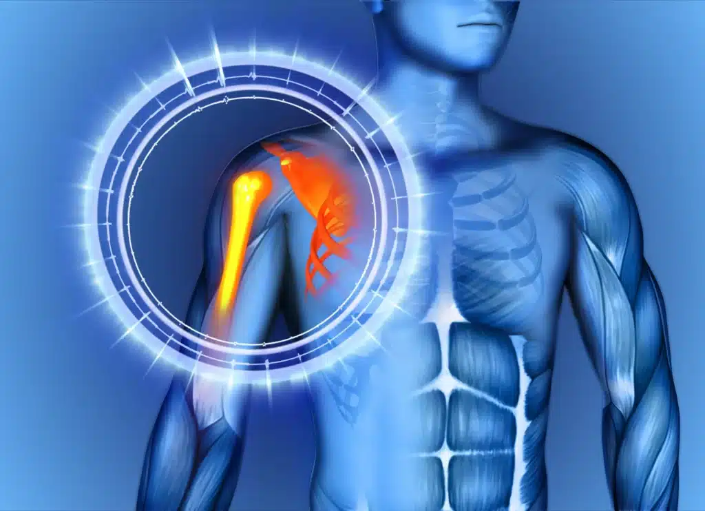 أنواع خلع الكتف