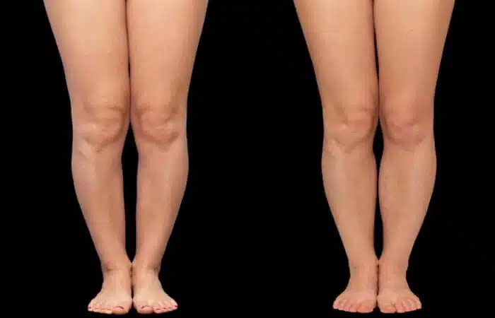 عملية تصحيح تقوس الساقين